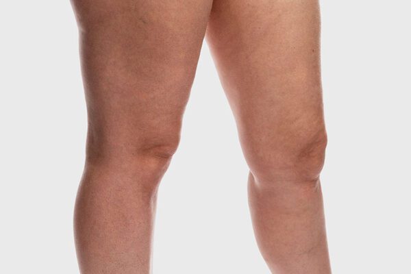 lipedema